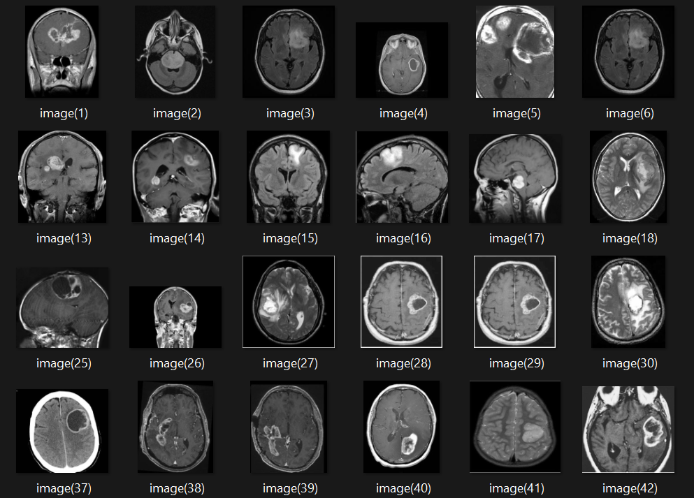Heart Disease Detection